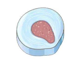 北京京通医院.膨出型腰间盘突出